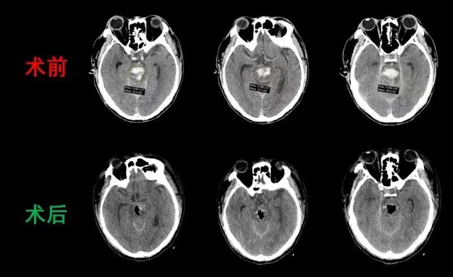 脑干出血,中年汉子命悬一线;专家联手,分秒必争化解危机(图5) 脑干出血,中年汉子命悬一线;专家联手,分秒必争化解危机(图5)