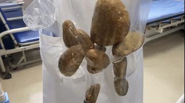 泸州:87岁大爷身体里掏出3斤石头(图2) 泸州:87岁大爷身体里掏出3斤石头(图2)