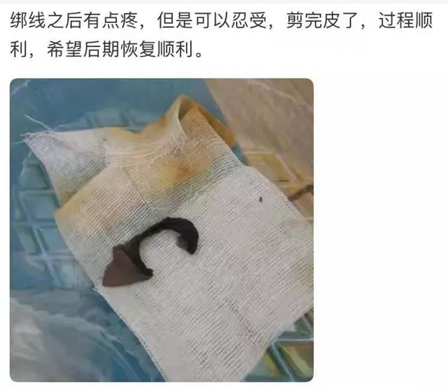 【围观】真猛！男子竟自己割包皮？