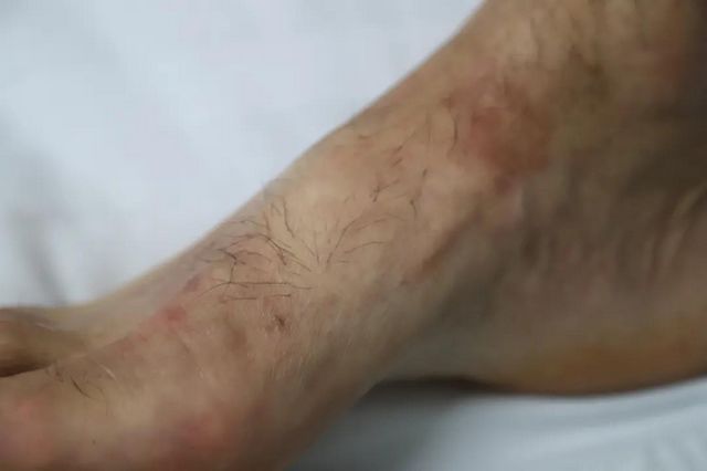 【扩散】致命“红火蚁”出没，泸州男子被咬伤入院(图3)