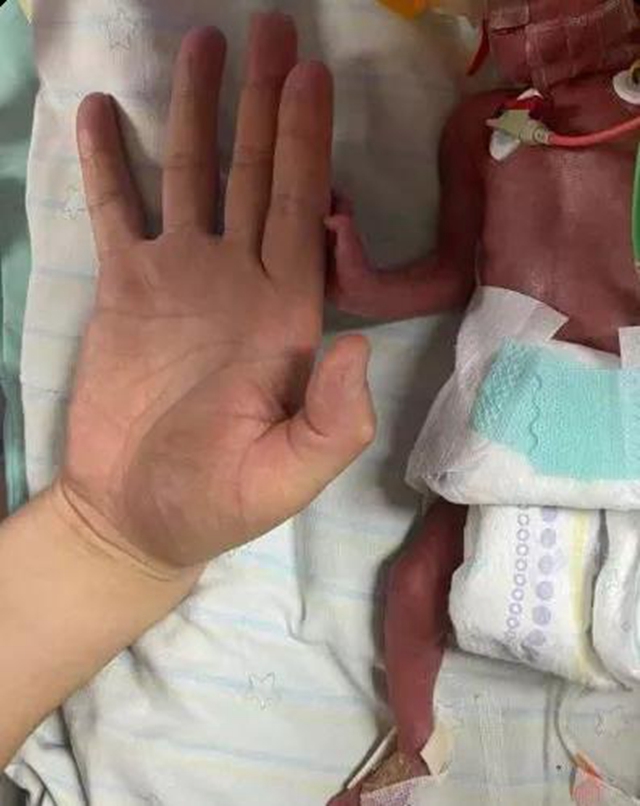 【围观】出生时仅2斤，又一“巴掌宝宝”闯关成功