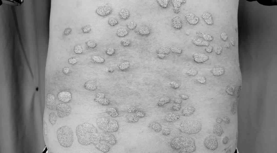 【围观】大妈全身瘙痒起红斑，还脱皮！(图2)