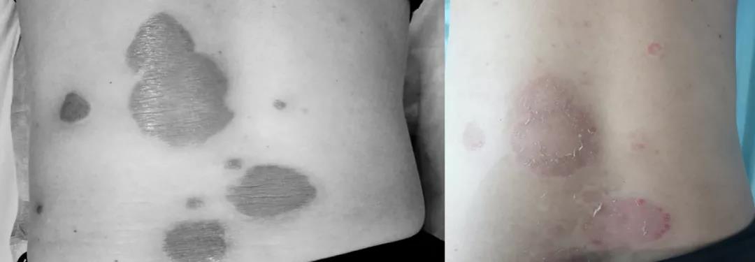 【围观】大妈全身瘙痒起红斑，还脱皮！(图4)