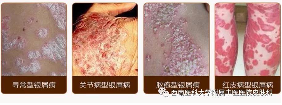 【围观】大妈全身瘙痒起红斑，还脱皮！(图6)