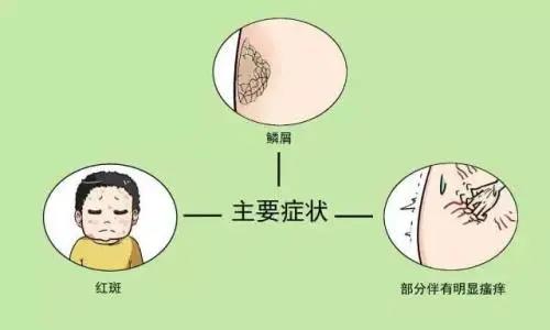 【围观】大妈全身瘙痒起红斑，还脱皮！(图7)