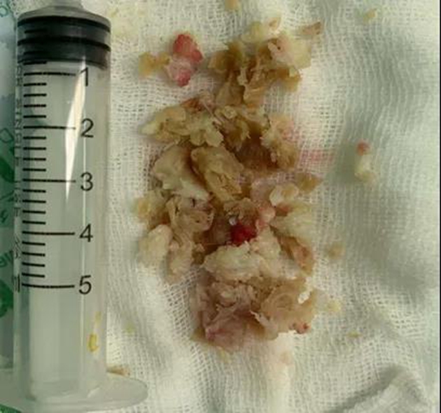 【关注】男子腰痛,医生取出21颗“骨头渣渣”!(图4) 【关注】男子腰痛,医生取出21颗“骨头渣渣”!(图4)