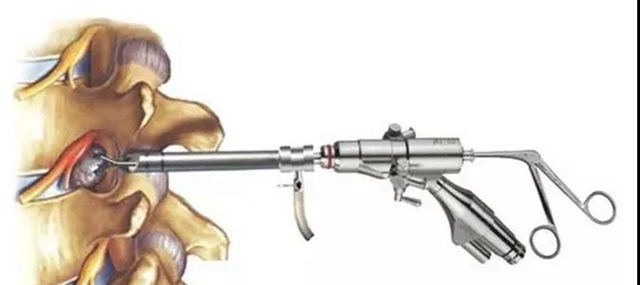 【关注】男子腰痛,医生取出21颗“骨头渣渣”!(图5) 【关注】男子腰痛,医生取出21颗“骨头渣渣”!(图5)