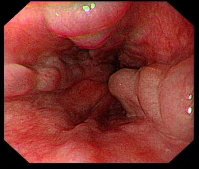 人体内的都江堰工程：为门静脉高压患者打通“生命通道”(图2)
