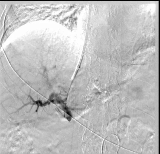 人体内的都江堰工程：为门静脉高压患者打通“生命通道”(图3)