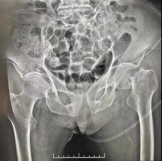 94岁老人一个月内摔倒两次，还好……