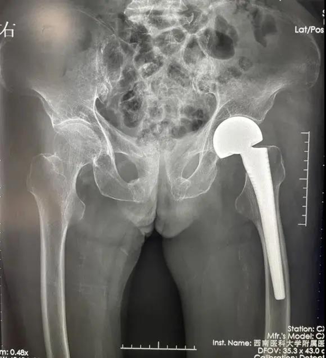 94岁老人一个月内摔倒两次,还好……(图2) 94岁老人一个月内摔倒两次,还好……(图2)