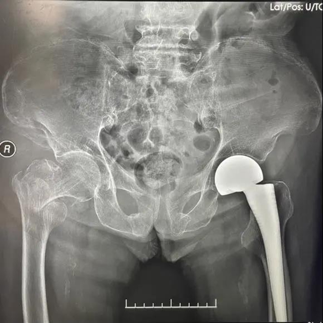 94岁老人一个月内摔倒两次,还好……(图5) 94岁老人一个月内摔倒两次,还好……(图5)