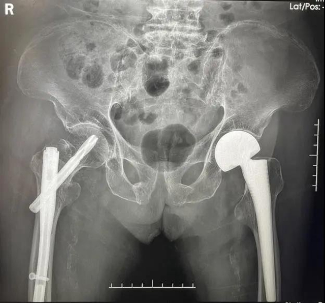 94岁老人一个月内摔倒两次,还好……(图6) 94岁老人一个月内摔倒两次,还好……(图6)