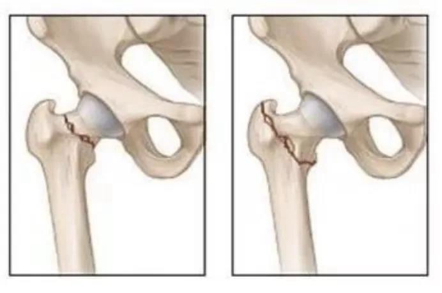 94岁老人一个月内摔倒两次,还好……(图9) 94岁老人一个月内摔倒两次,还好……(图9)