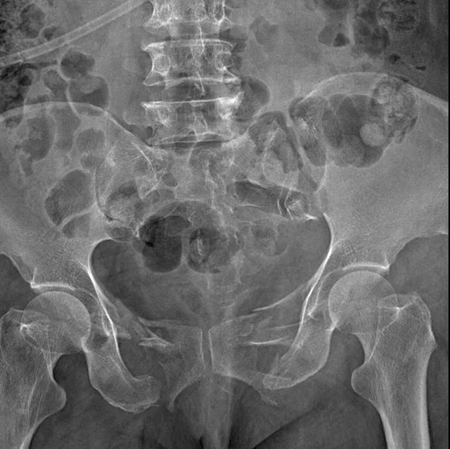 【技术】嬢嬢不慎骨盆骨折，INFIX微创手术解难题！(图2)