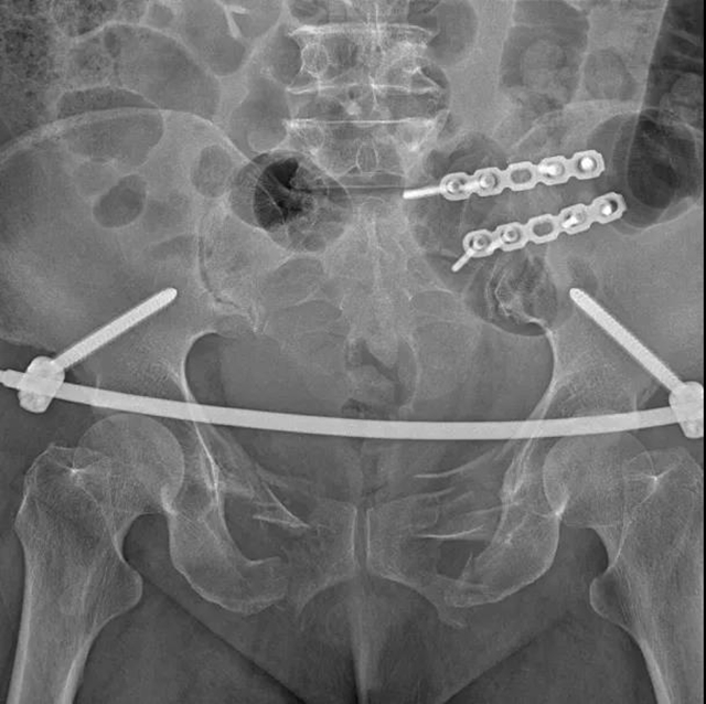 【技术】嬢嬢不慎骨盆骨折，INFIX微创手术解难题！(图3)
