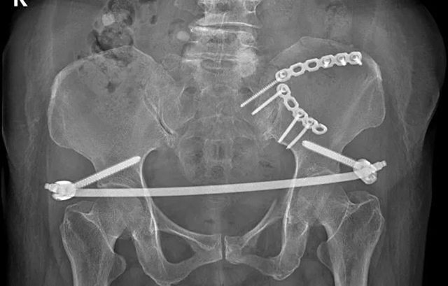 【技術】嬢嬢不慎骨盆骨折,infix微創手術解難題!