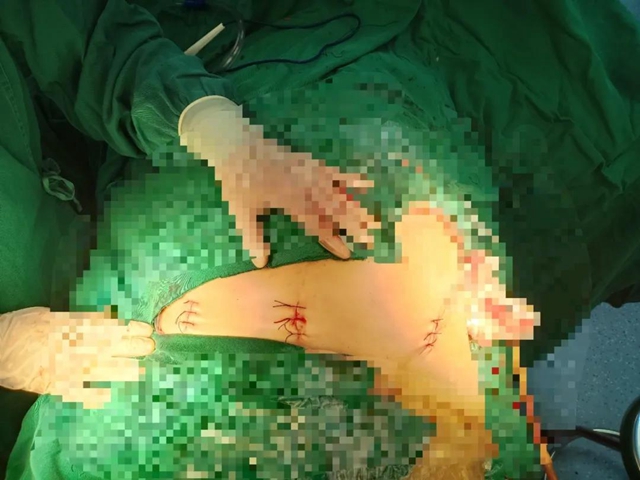 【技术】嬢嬢不慎骨盆骨折，INFIX微创手术解难题！(图5)