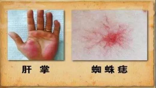 【扩散】肝癌患者请注意，西南医大中医院可免费治疗！(图8)