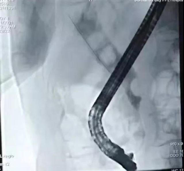 突破极限！泸州市人民医院为2名九旬老人实施ERCP取石术