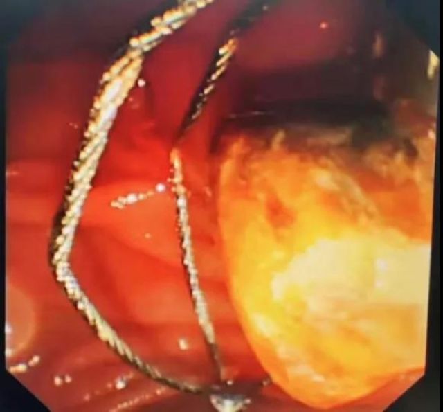 突破极限!泸州市人民医院为2名九旬老人实施ERCP取石术(图2) 突破极限!泸州市人民医院为2名九旬老人实施ERCP取石术(图2)