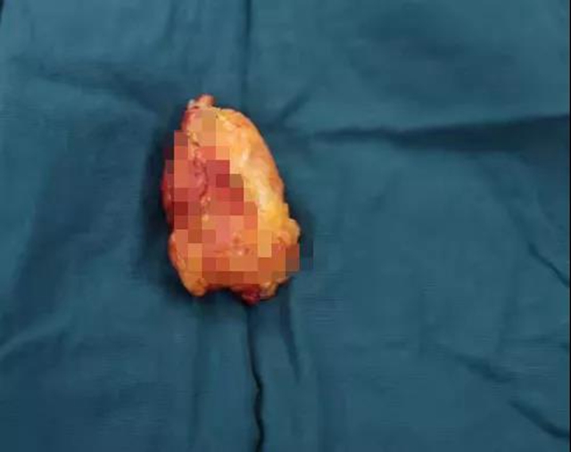 【围观】拿碗端水都很困难,被查出癌?(图5) 【围观】拿碗端水都很困难,被查出癌?(图5)