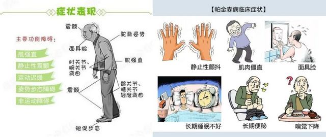 【义诊在即】它被称为“不死的癌症”,手抖只是其中一种表现(图2) 1.jpg