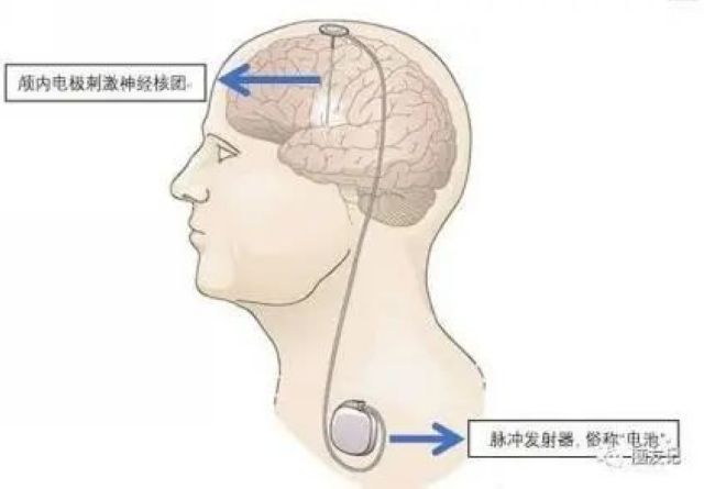 【义诊在即】它被称为“不死的癌症”,手抖只是其中一种表现(图3) nEO_IMG_2.jpg