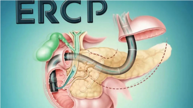 【扩散】不开刀就可以取结石?(图3) 33.jpg