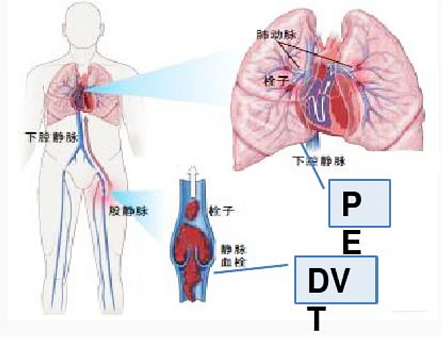 “沉默的杀手” ——静脉血栓如何预防？