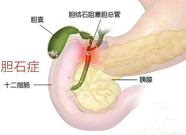 【警惕】痛痛痛,痛如刀割,这样的肚子痛当心要手术......(图3) nEO_IMG_3.jpg